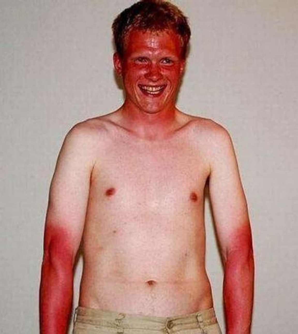 Of The Worst Sunburns