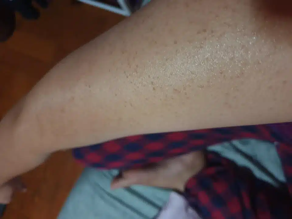 Red Bumps on Your Arms
