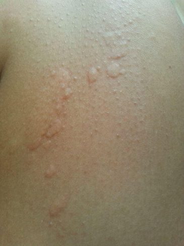 Cold Urticaria: Symptoms And Treatment - Usa Stories