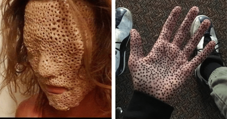 Trypophobia: 15 Pics That Will Make You Cry in Fear