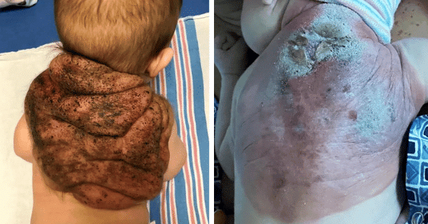 Baby James, the 'Little Ninja-Turtle' Born with 75% Back Growth