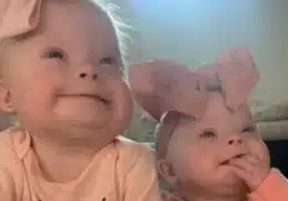 Rare Down Syndrome Twins