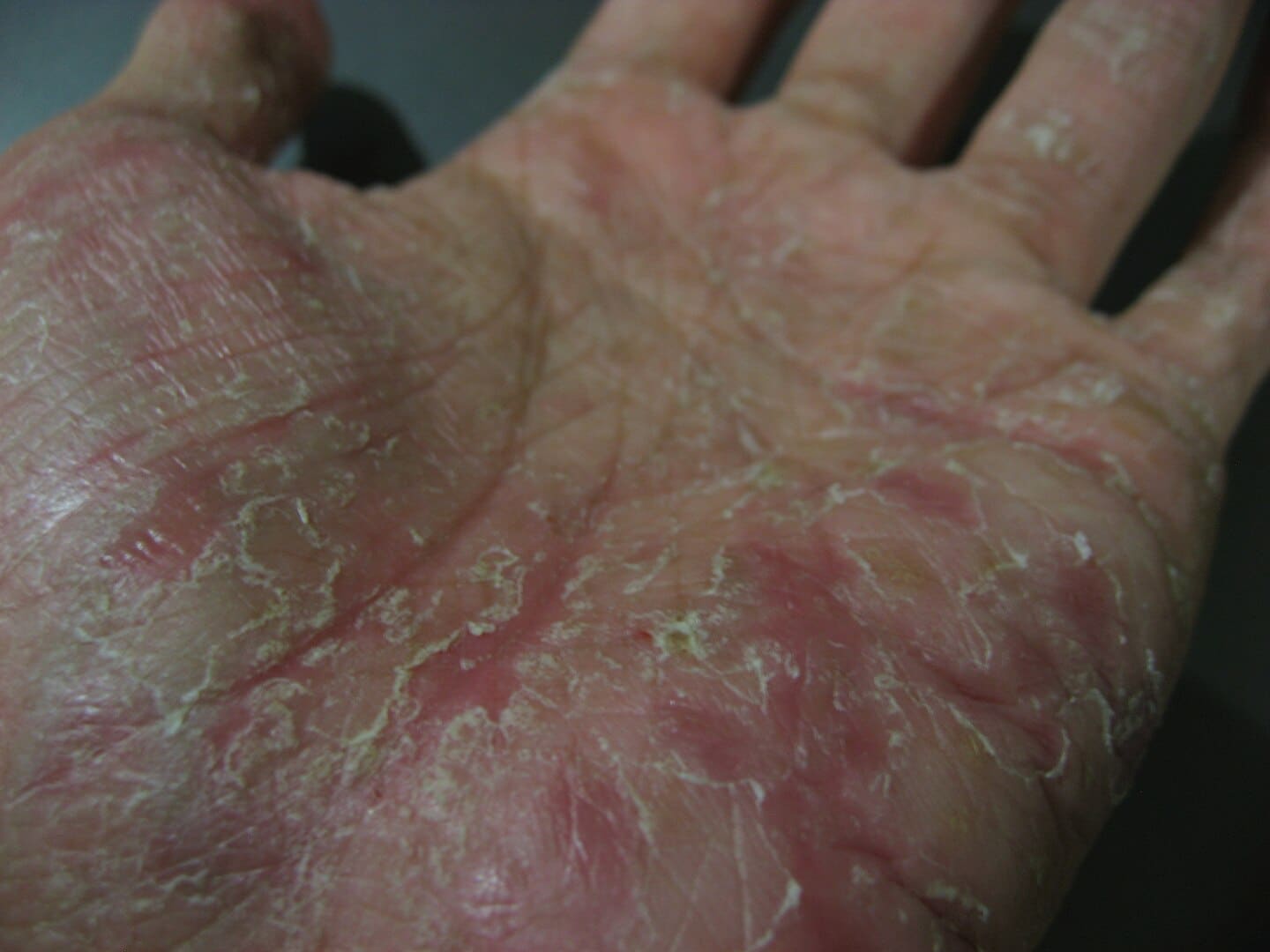 Dyshidrotic Eczema