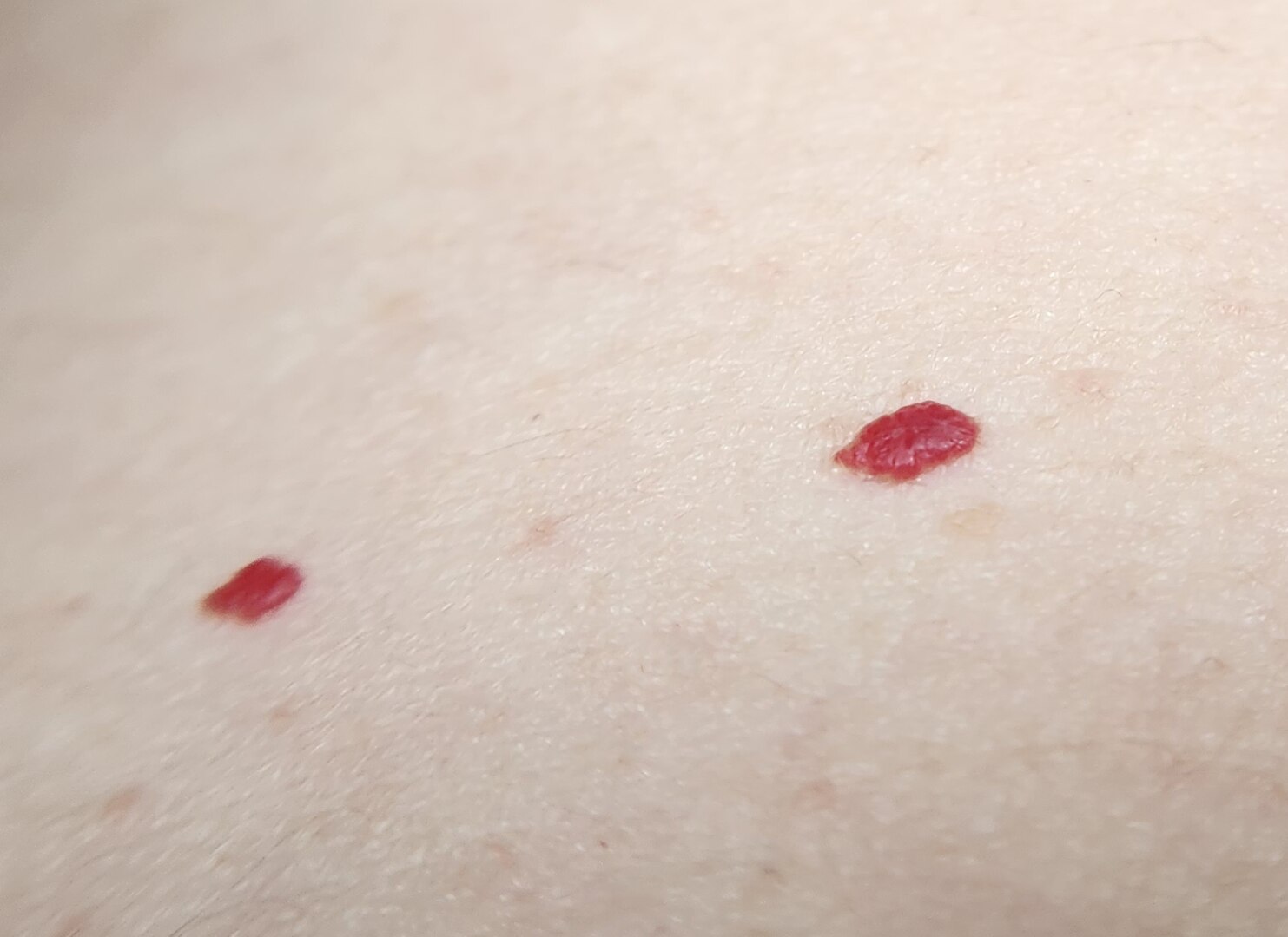 Cherry Angiomas