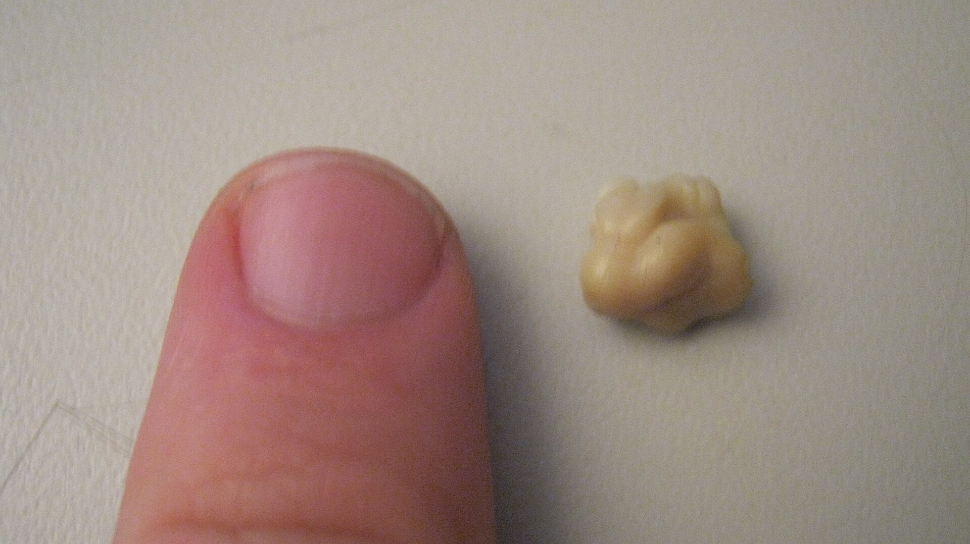 Tonsil Stones