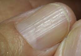 Ridges on Nails