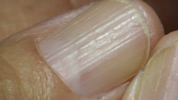 Ridges on Nails