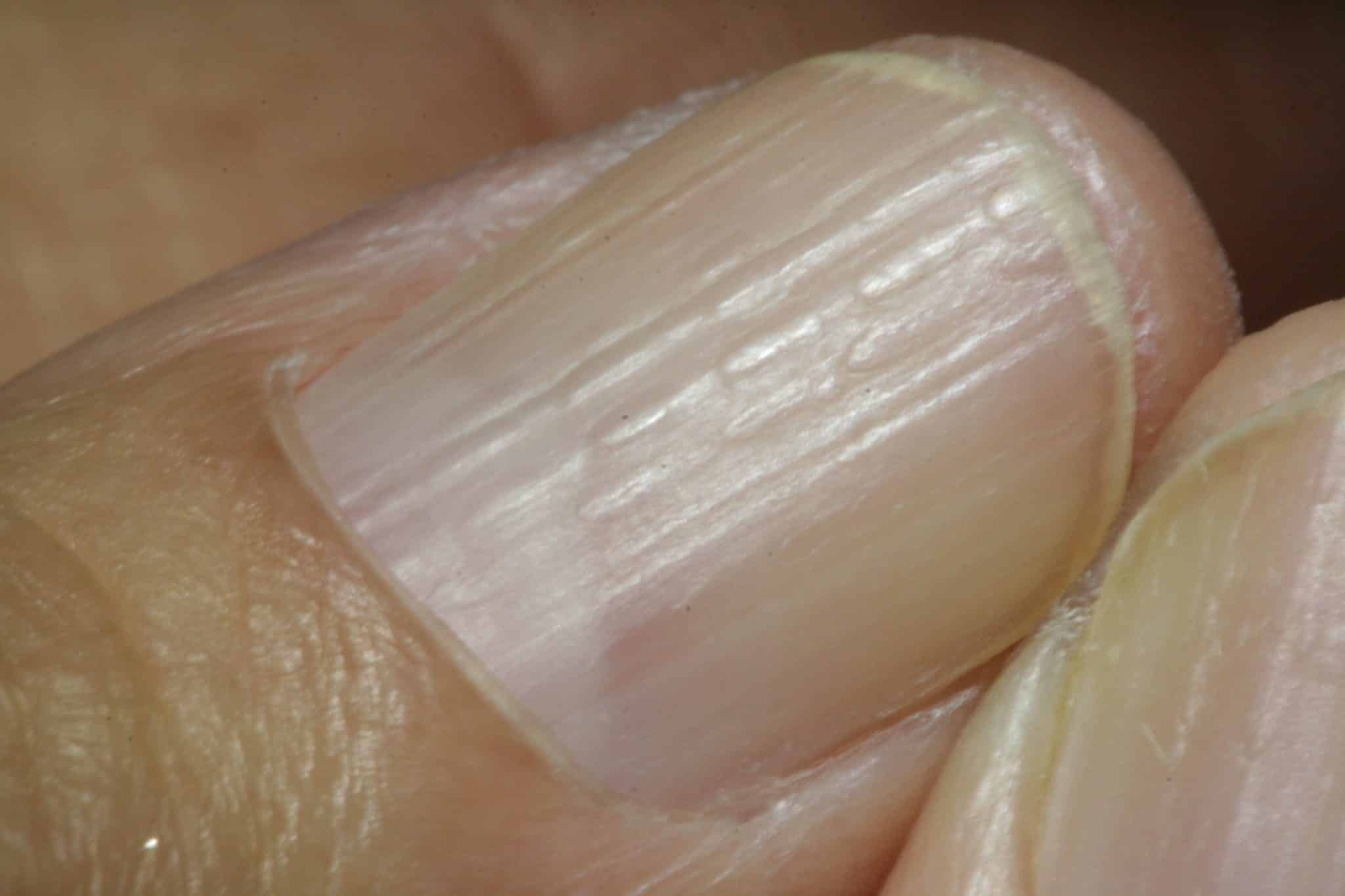 Ridges on Nails