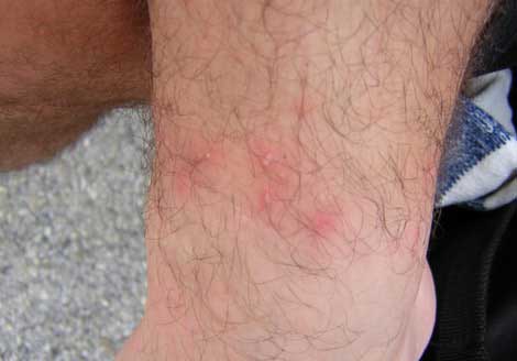 Bug Bites