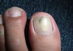 Nail Fungus