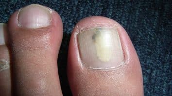 Nail Fungus