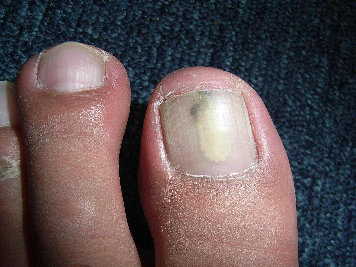 Nail Fungus