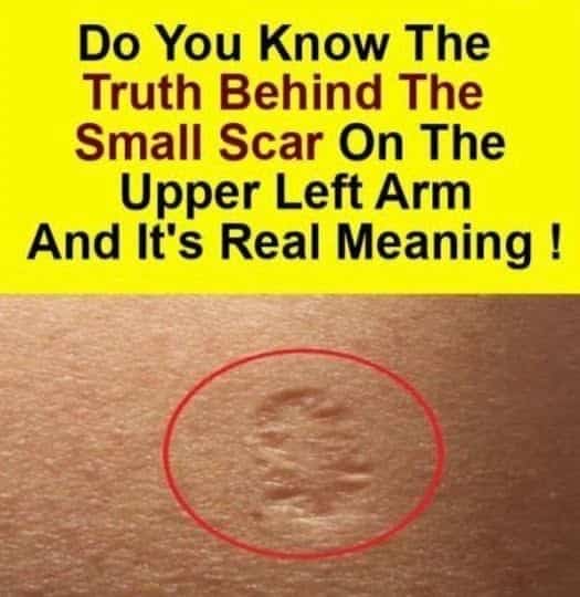 Smallpox Vaccination
