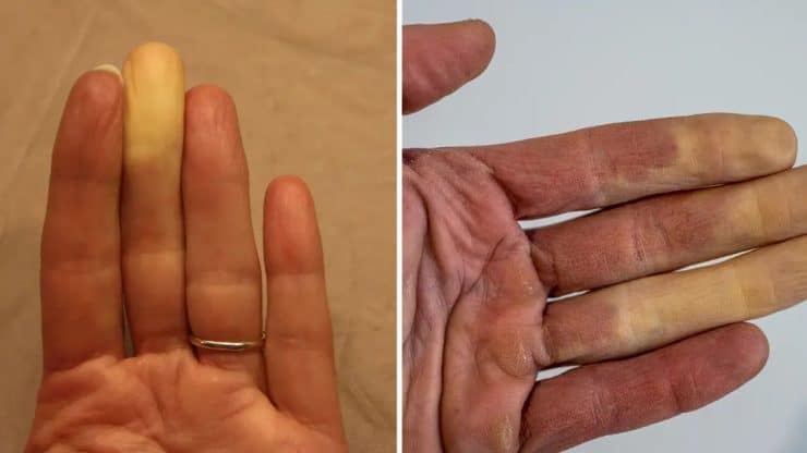 Raynaud's Phenomenon