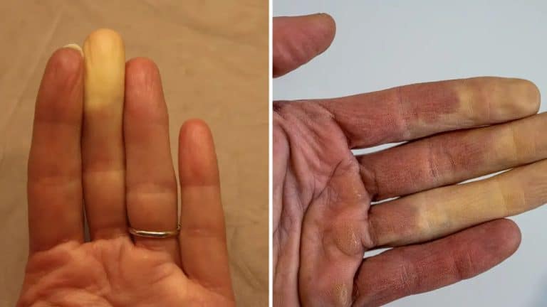 Raynaud's Phenomenon